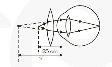 Make a diagram to show how hypermetropia is corrected. The near point of a hypermetropic eye is 1 m. What is the power of the lens required to correct this defect ? Assume that the near point of the normal eye is 25 cm.